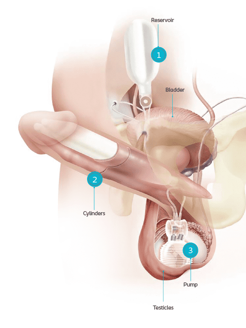 Penile Prosthesis SB Urology