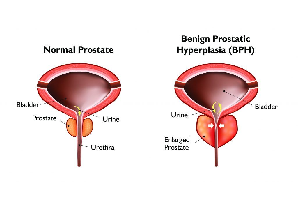 BPH – SB Urology